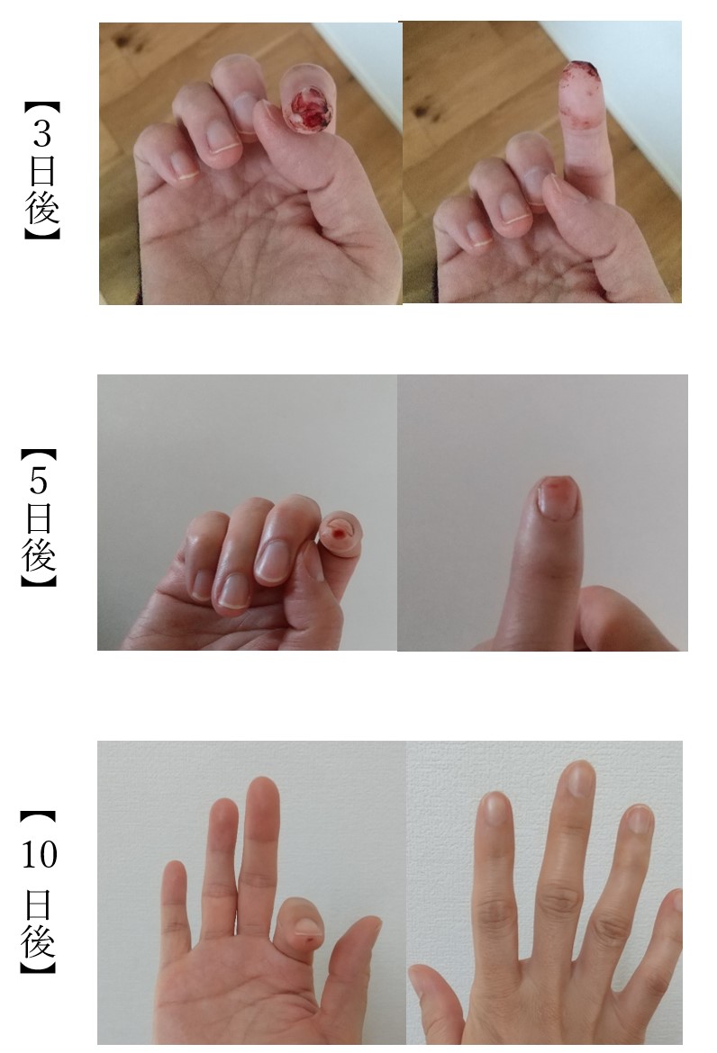 スライサーで指を切った まずするべき治療法とは 処置の仕方など 生活の知恵
